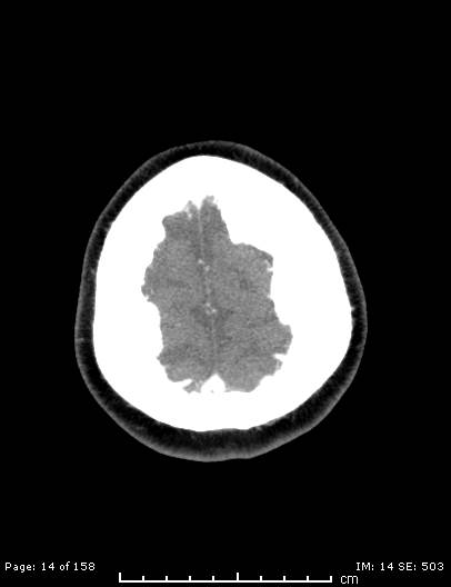 Cerebellar strokes due to intracranial giant cell arteritis (Radiopaedia 68799-78510 CT angiogram 14).jpg