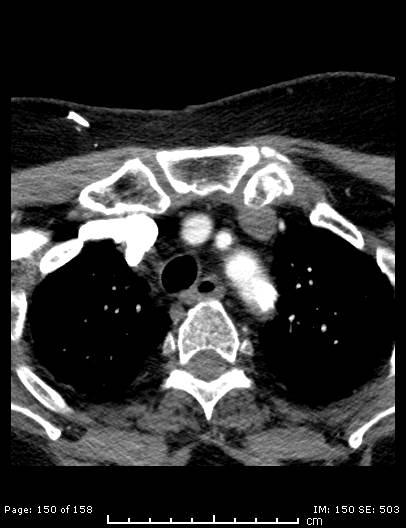 Cerebellar strokes due to intracranial giant cell arteritis (Radiopaedia 68799-78510 CT angiogram 150).jpg