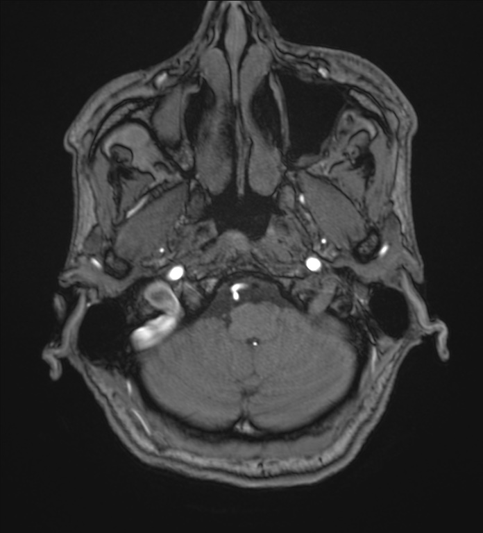 Cerebellopontine angle meningioma (Radiopaedia 72983-83680 Axial MRA 9).jpg