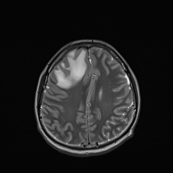 Cerebral abscess (Radiopaedia 24212-24478 Axial T2 44).jpg