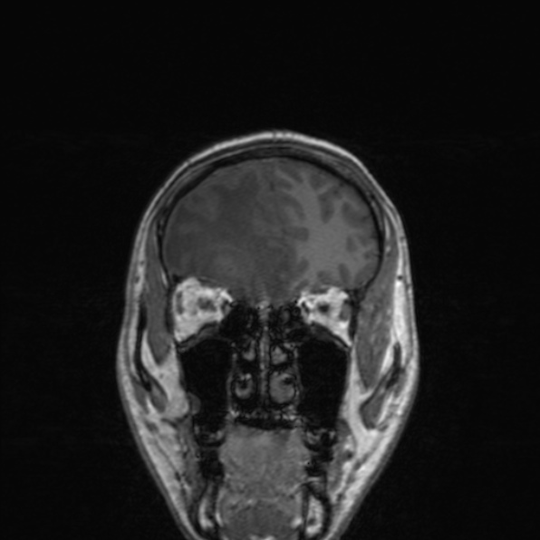 Cerebral abscess (Radiopaedia 24212-24478 Coronal T1 57).jpg