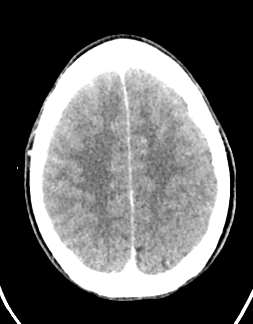 Cerebral abscess (Radiopaedia 60342-68008 Axial C+ delayed 39).png