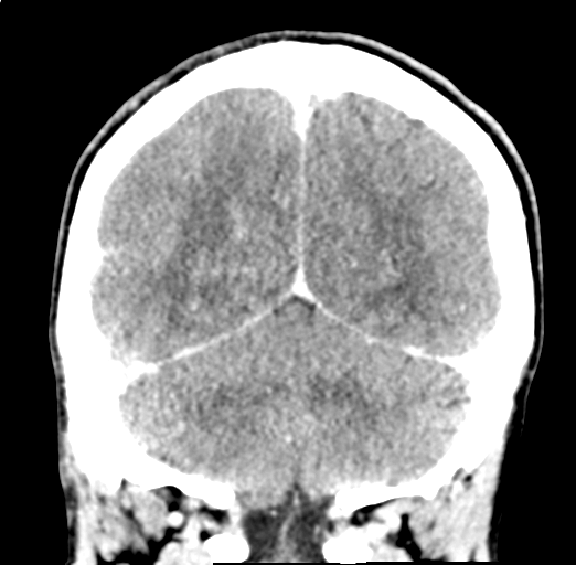 Cerebral abscess (Radiopaedia 60342-68008 Coronal C+ delayed 50).png