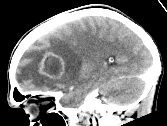 Cerebral abscess (Radiopaedia 60342-68008 Sagittal C+ delayed 34).png