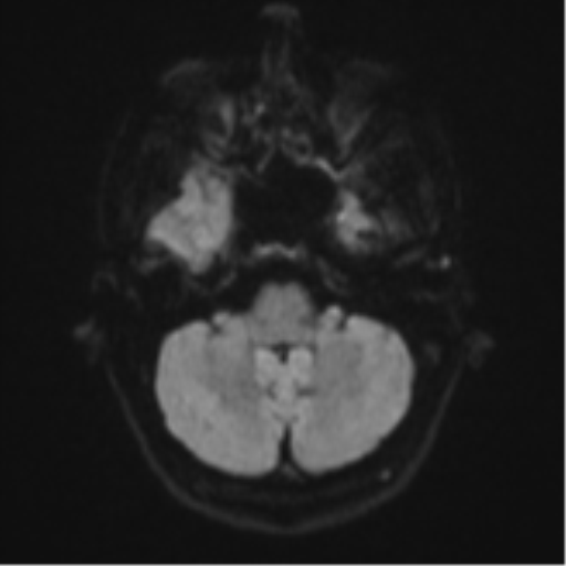 Cerebral abscess (Radiopaedia 60342-68009 Axial DWI 43).png