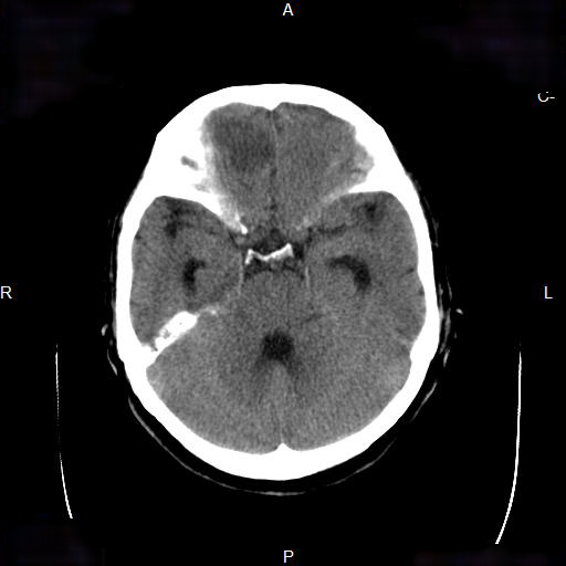File:Cerebral abscess (Radiopaedia 7606-8431 Axial non-contrast 11).jpg