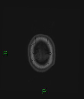 Cerebral abscess and subdural empyema (Radiopaedia 84436-99779 Axial T1 8).jpg