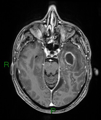 Cerebral abscess and subdural empyema (Radiopaedia 84436-99779 Axial T1 C+ 55).jpg