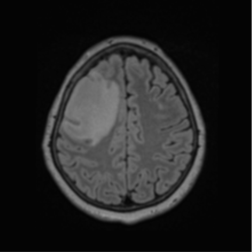 Cerebral abscess from pulmonary arteriovenous malformation (Radiopaedia 86275-102291 J 56).png