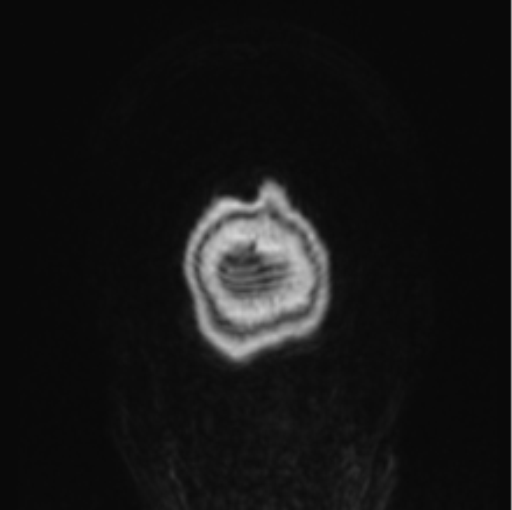 File:Cerebral abscess from pulmonary arteriovenous malformation (Radiopaedia 86275-102291 L 2).png