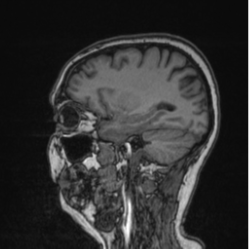 Cerebral abscess from pulmonary arteriovenous malformation (Radiopaedia 86275-102291 Sagittal T1 39).png