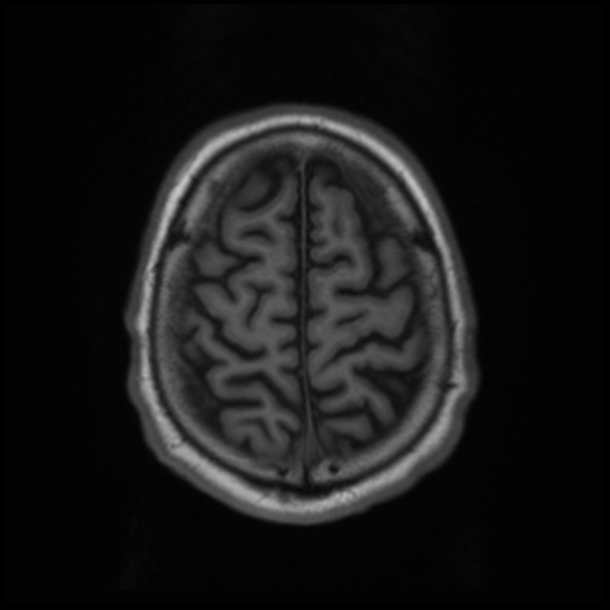 File:Cerebral abscess with ventriculitis (Radiopaedia 78965-91878 Axial T1 42).jpg