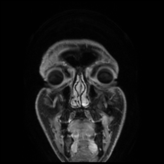 Cerebral abscess with ventriculitis (Radiopaedia 78965-91878 Coronal T1 C+ 7).jpg