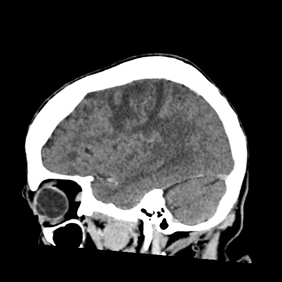 Cerebral amyloid angiopathy-related inflammation (Radiopaedia 74836-85848 C 17).jpg