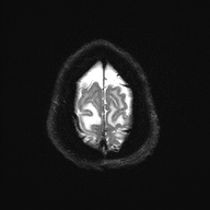 Cerebral amyloid angiopathy-related inflammation (Radiopaedia 74836-85849 Axial DWI 27).jpg