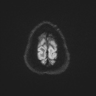 Cerebral amyloid angiopathy-related inflammation (Radiopaedia 74836-85849 Axial DWI 58).jpg