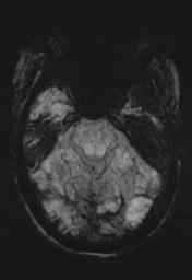 File:Cerebral amyloid angiopathy (Radiopaedia 29129-29518 Axial SWI MIP 9).jpg