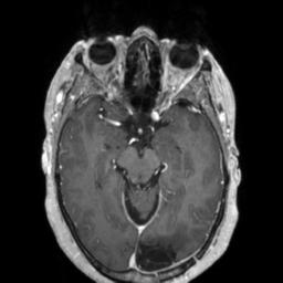 Cerebral amyloid angiopathy (Radiopaedia 29129-29518 Axial T1 C+ 61).jpg