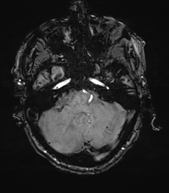 File:Cerebral amyloid angiopathy (Radiopaedia 46082-50433 Axial SWI 18).png