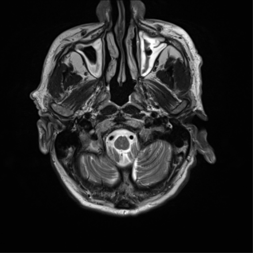 File:Cerebral amyloid angiopathy (Radiopaedia 46082-50433 Axial T2 4).png