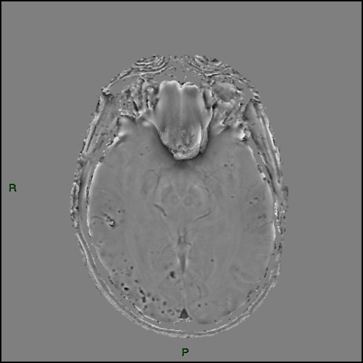 Cerebral amyloid angiopathy (Radiopaedia 77506-89664 H 47).jpg