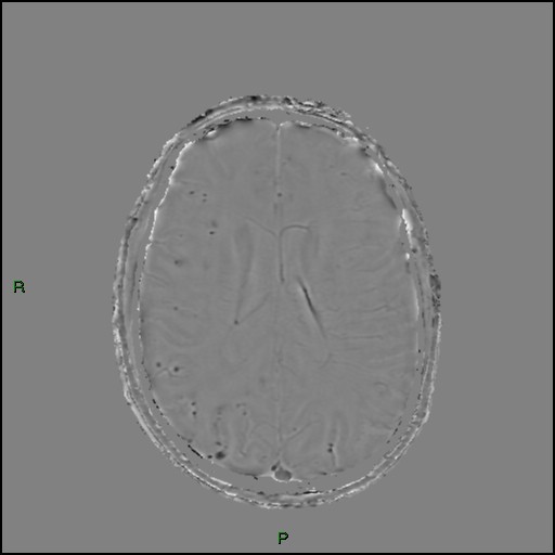 Cerebral amyloid angiopathy (Radiopaedia 77506-89664 H 63).jpg