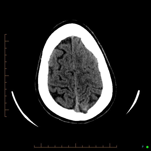 File:Cerebral arteriovenous malformation (AVM) (Radiopaedia 78162-90706 Axial non-contrast 55).jpg