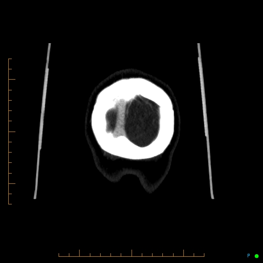 Cerebral arteriovenous malformation (AVM) (Radiopaedia 78162-90706 Coronal CTA 9).jpg