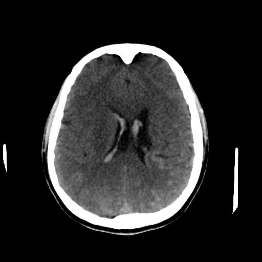 Cerebral arteriovenous malformation (Radiopaedia 28518-28759 Axial non-contrast 45).jpg