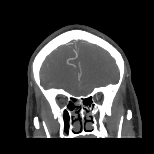 Cerebral arteriovenous malformation (Radiopaedia 39259-41505 E 17).png