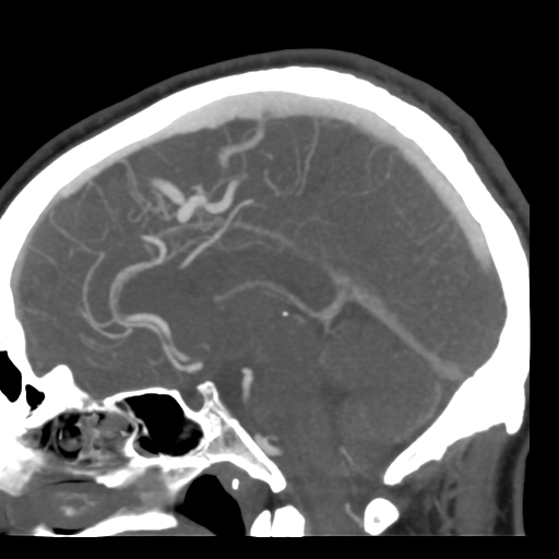 Cerebral arteriovenous malformation (Radiopaedia 39259-41505 Sagittal 32).png