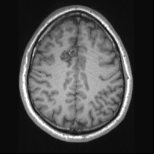 Cerebral arteriovenous malformation (Radiopaedia 39259-41506 Axial T1 55).png