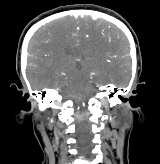 Cerebral arteriovenous malformation (Radiopaedia 73830-84645 C 59).jpg