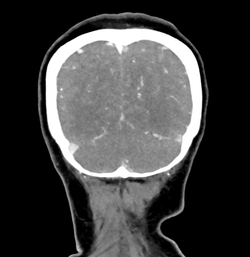 Cerebral arteriovenous malformation (Radiopaedia 73830-84645 C 83).jpg