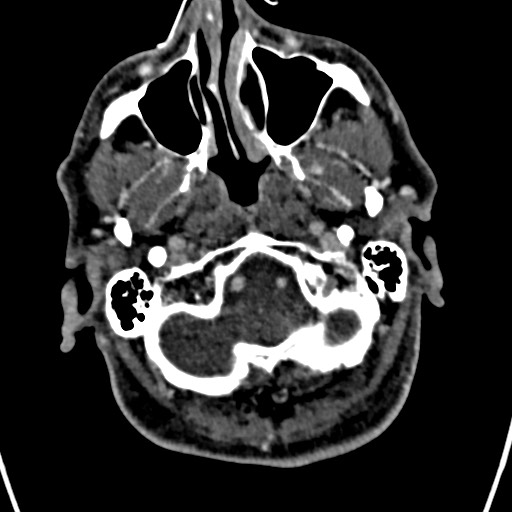 Cerebral arteriovenous malformation (Radiopaedia 78188-90746 Axial C+ delayed 18).jpg