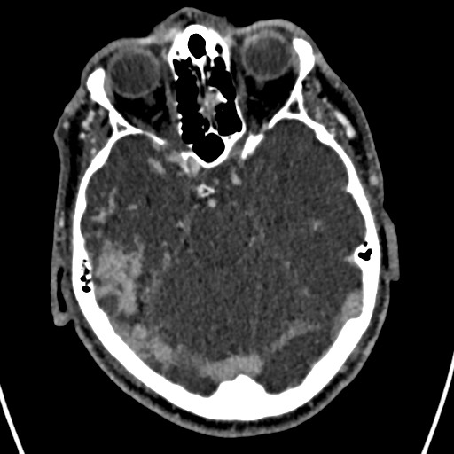 Cerebral arteriovenous malformation (Radiopaedia 78188-90746 Axial C+ delayed 58).jpg