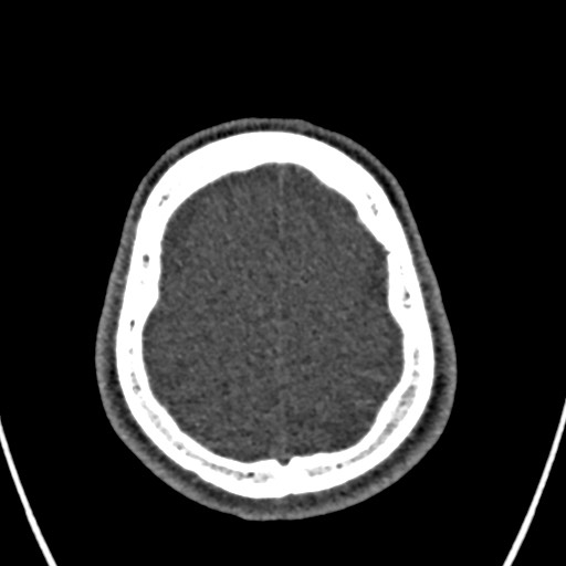 Cerebral arteriovenous malformation (Radiopaedia 78188-90746 Axial non-contrast 153).jpg