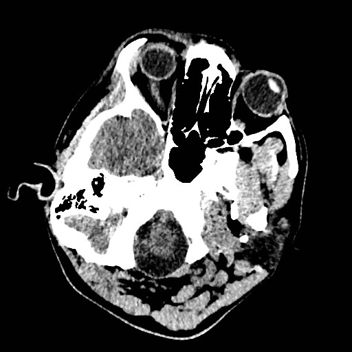 Cerebral arteriovenous malformation (Radiopaedia 79677-92887 Axial non-contrast 4).jpg