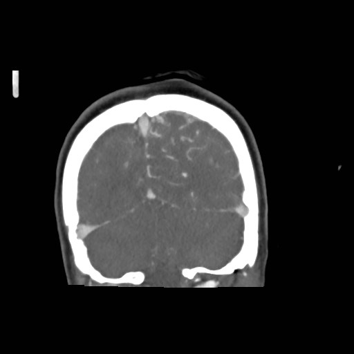 File:Cerebral arteriovenous malformation (Radiopaedia 79677-92888 B 41).jpg