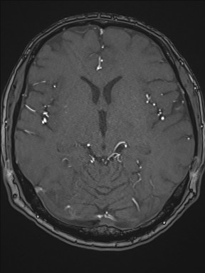 Cerebral arteriovenous malformation (Radiopaedia 84015-99245 Axial TOF 119).jpg