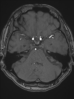Cerebral arteriovenous malformation (Radiopaedia 84015-99245 Axial TOF 86).jpg