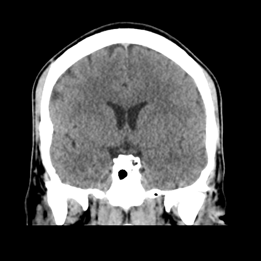 Cerebral arteriovenous malformation (Spetzler-Martin grade 2) (Radiopaedia 41262-44076 Coronal non-contrast 27).png