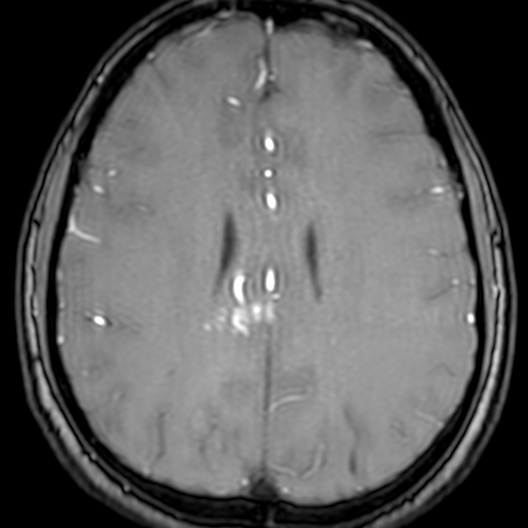 Cerebral arteriovenous malformation at posterior body of corpus callosum (Radiopaedia 74111-84925 Axial MRA 145).jpg