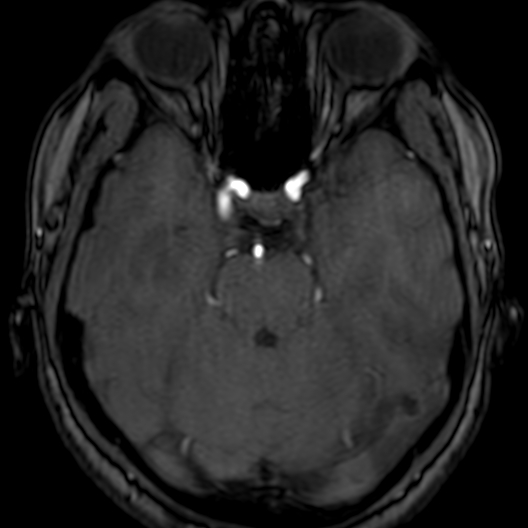 Cerebral arteriovenous malformation at posterior body of corpus callosum (Radiopaedia 74111-84925 Axial MRA 64).jpg