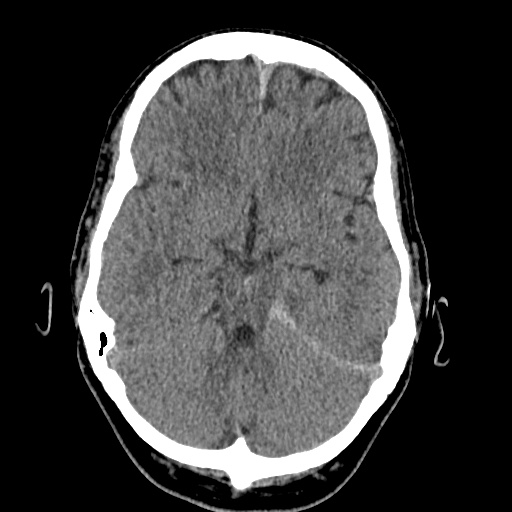 Cerebral arteriovenous malformation with lobar hemorrhage (Radiopaedia 35598-37117 Axial non-contrast 18).jpg