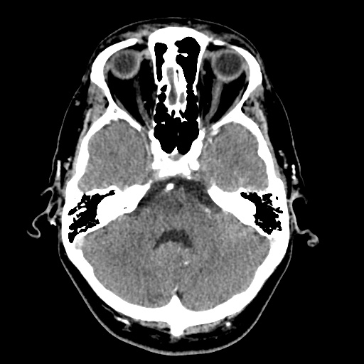 Cerebral arteriovenous malformation with lobar hemorrhage (Radiopaedia 35598-57216 A 16).jpg