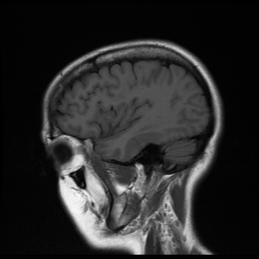 File:Cerebral autosomal dominant arteriopathy with subcortical infarcts and leukoencephalopathy (CADASIL) (Radiopaedia 41018-43768 Sagittal T1 16).png