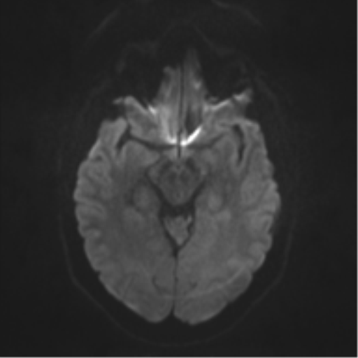 File:Cerebral cavernoma and development venous anomaly (Radiopaedia 37603-39482 Axial DWI 33).png