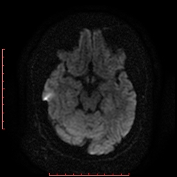 File:Cerebral cavernous malformation (Radiopaedia 26177-26306 Axial DWI 9).jpg
