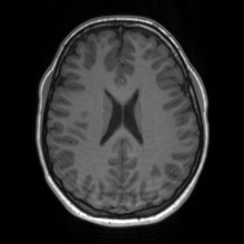 Cerebral cavernous venous malformation (Radiopaedia 70008-80021 Axial T1 48).jpg